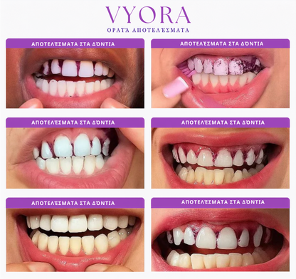 VYORA™ Purple Whitening Strips