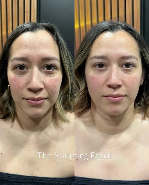 Înainte și după Peria Reset Vyora, cu un contur facial natural mai vizibil